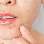 عوارض اسیدتراپی پوست صورت؛ چه زمانی باید نگران باشیم؟