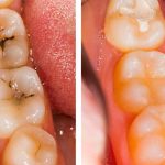 فیشور سیلانت چیست ؟