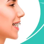 آیا ارتودنسی همزمان با عمل بینی امکان پذیر است؟