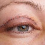 بلفاروپلاستی؛ جراحی برای جوان‌تر شدن چشم‌ها، نه تغییر فرم آن‌ها”